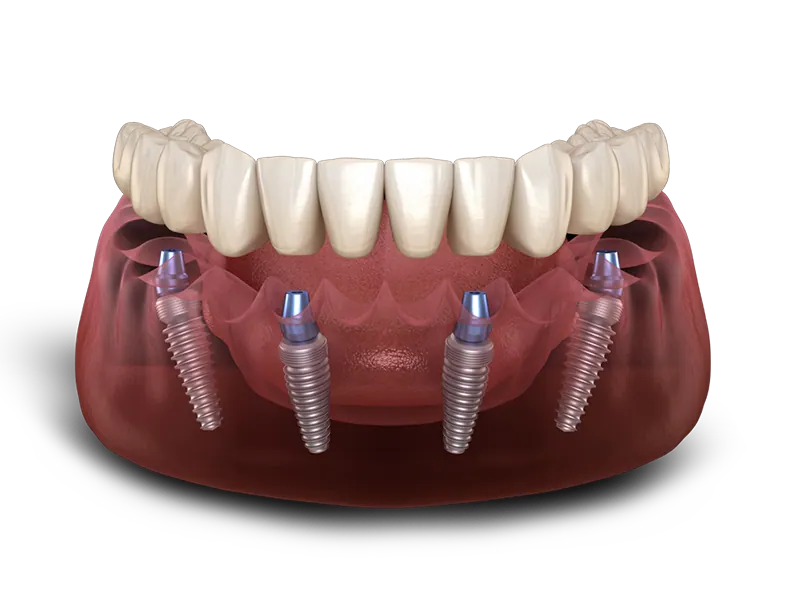 All-on-4 full arch implant model