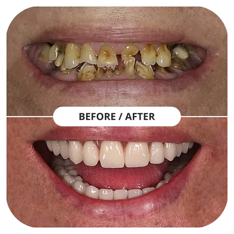Before and after full-mouth restoration — Magnolia Dentistry, Burbank