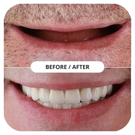 Before and after natural crowns — Magnolia Dentistry, Burbank