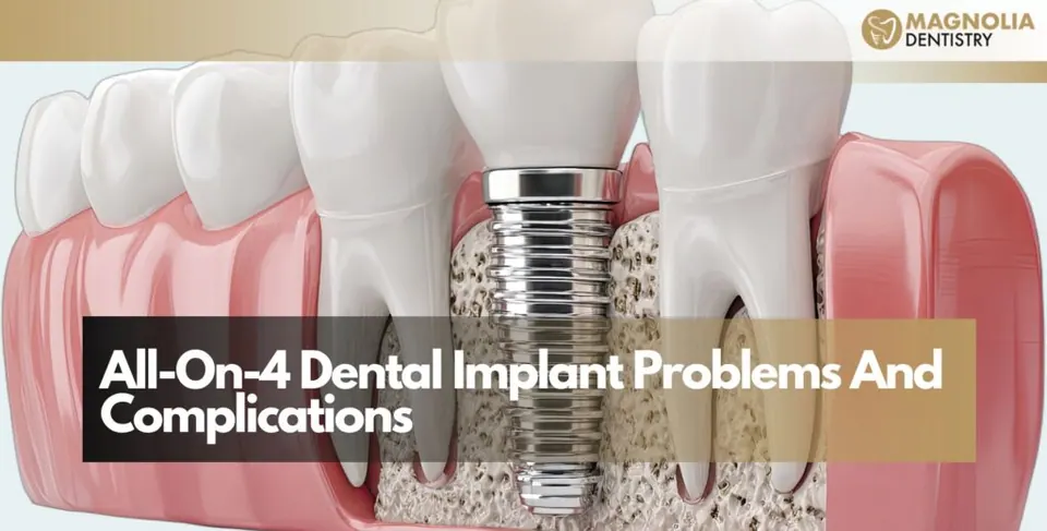 All-On-4 Dental Implant Problems And Complications