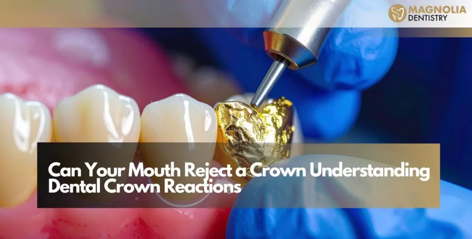 Can Your Mouth Reject a Crown Understanding Dental Crown Reactions
