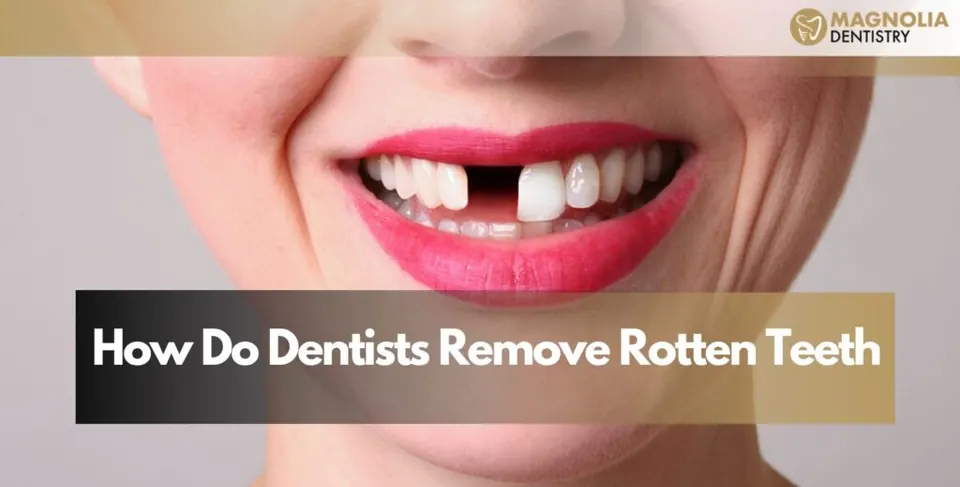 How Do Dentists Remove Rotten Teeth