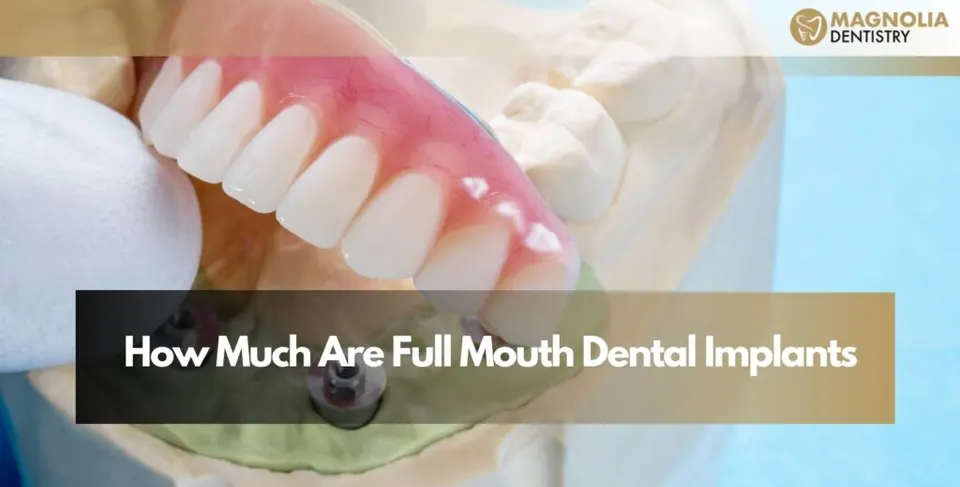 How Much Are Full Mouth Dental Implants