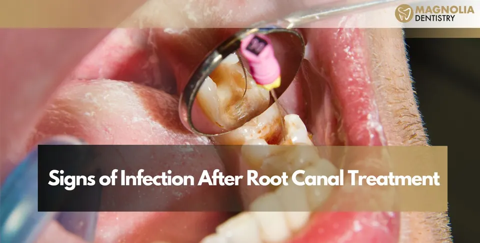 Signs of Infection After Root Canal Treatment