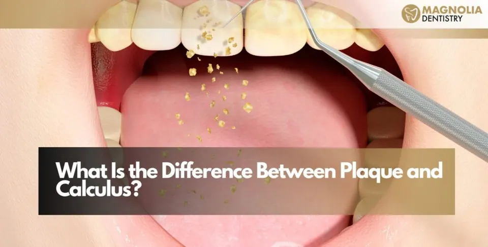 What Is the Difference Between Plaque and Calculus