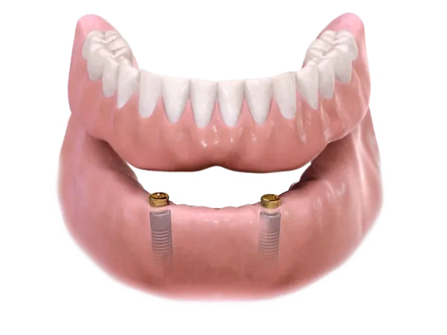 Comparison of fixed and removable implant-supported teeth