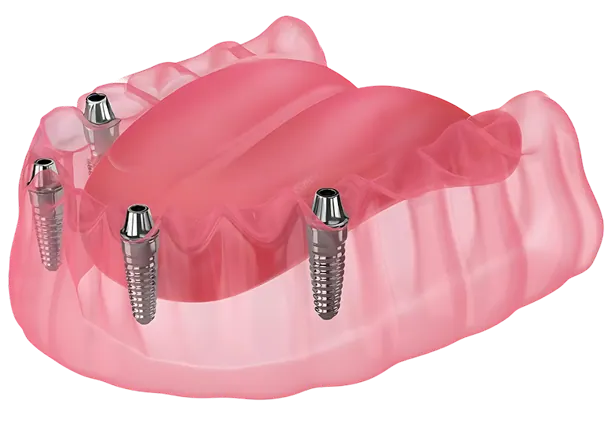 Model of an implant-supported dental bridge