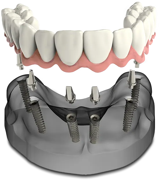 Implant-supported denture