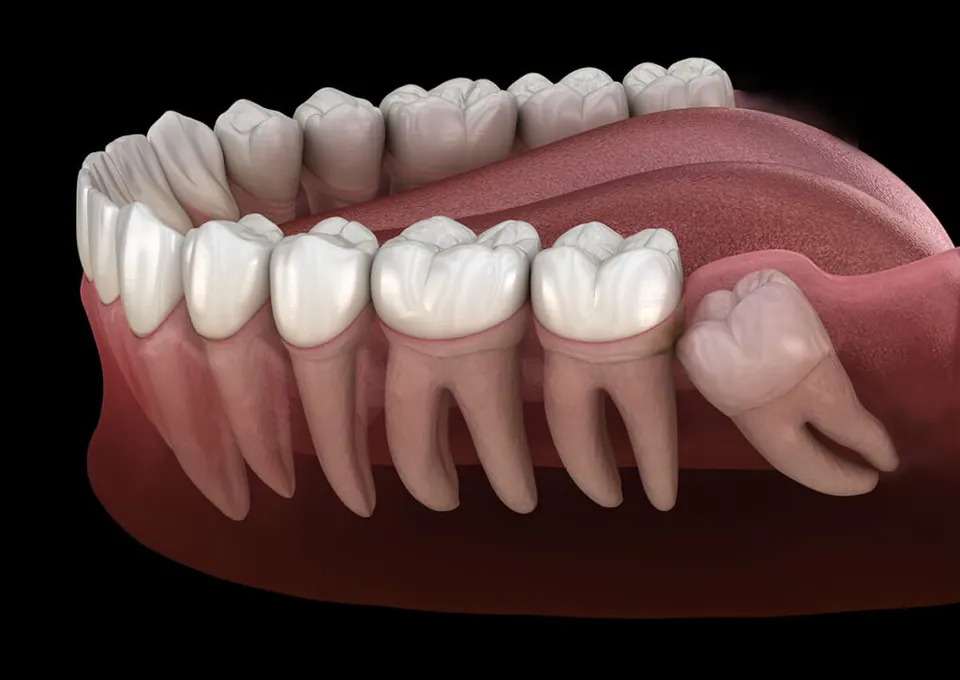 Illustration of an impacted wisdom tooth being removed