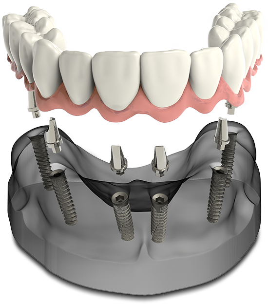 Implant supported dentures