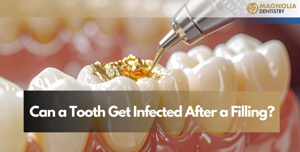 Can a Tooth Get Infected After a Filling?