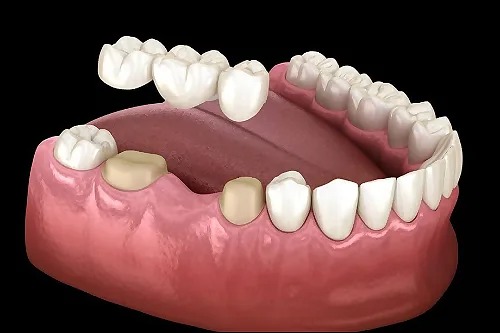 Dental Bridges in burbank