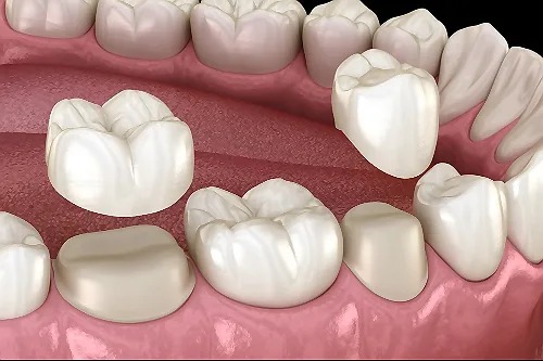 Dental Crowns in burbank