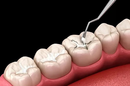Dental Fillings in burbank
