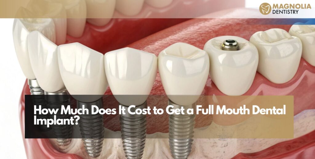How Much Does It Cost to Get a Full Mouth Dental Implant?