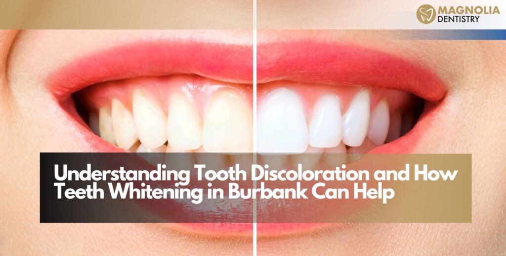 Understanding Tooth Discoloration and How Teeth Whitening in Burbank Can Help