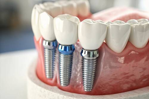 dental implant surgery
