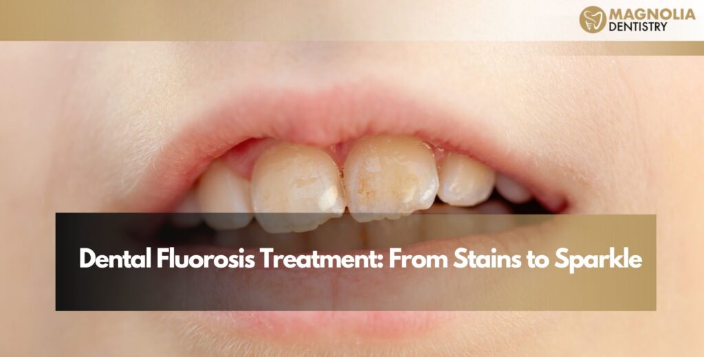 Dental Fluorosis Treatment: From Stains to Sparkle