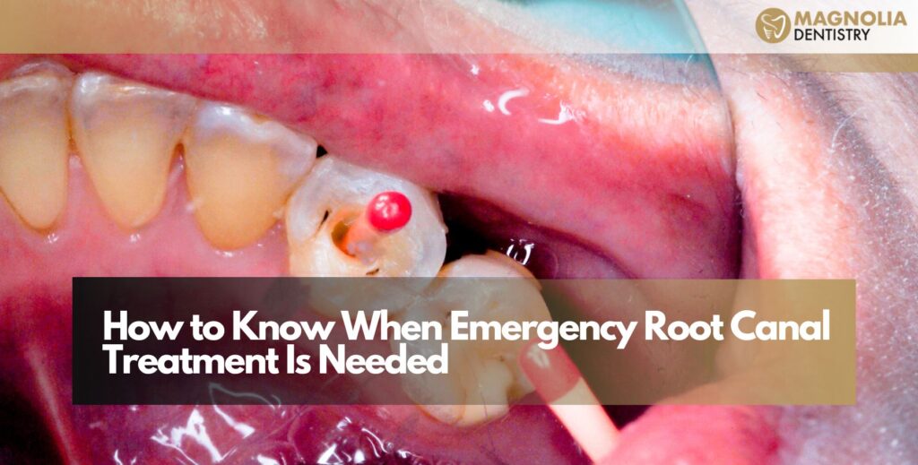 Emergency Root Canal Treatment