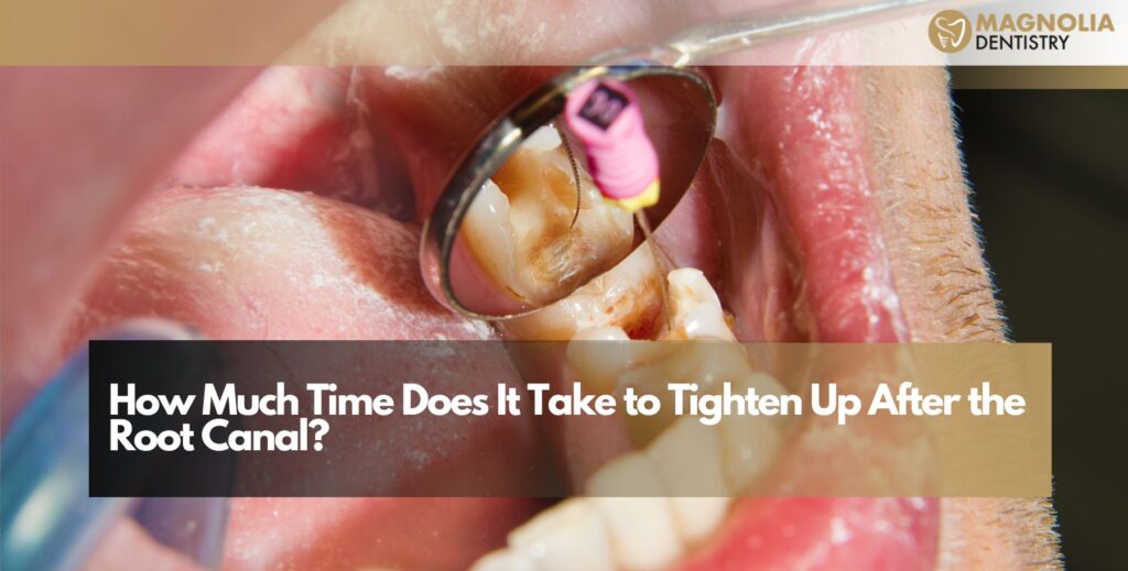 How Much Time Does It Take to Tighten Up After the Root Canal