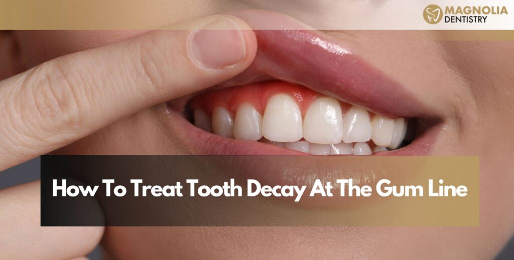 How To Treat Tooth Decay At The Gum Line