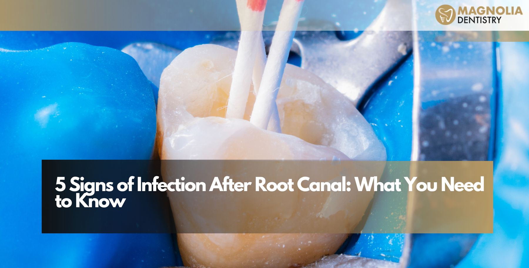 Fresh Look at 5 Signs Of Infection After Root Canal