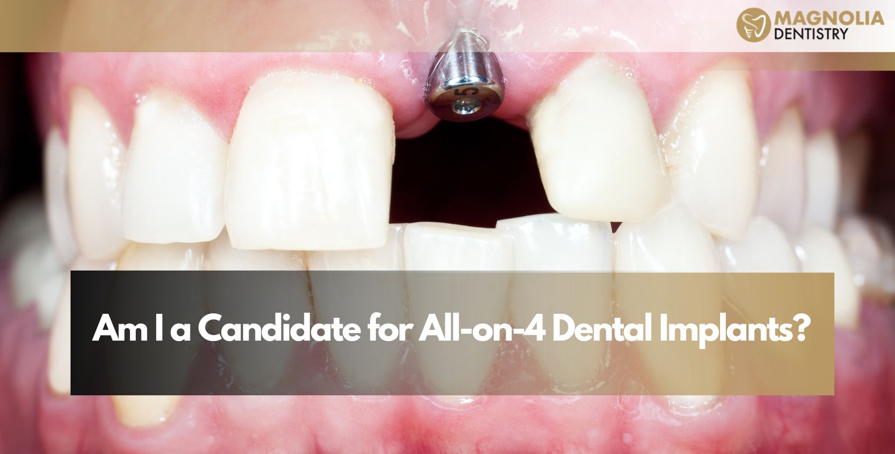 Am I a Candidate for All-on-4 Dental Implants | Magnolia Dentistry
