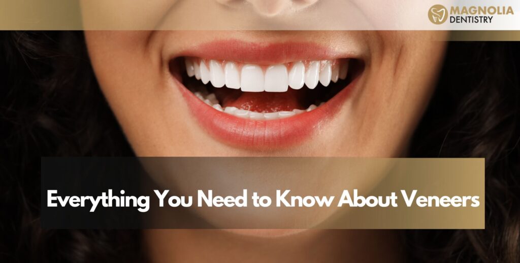 Everything You Need to Know About Veneers