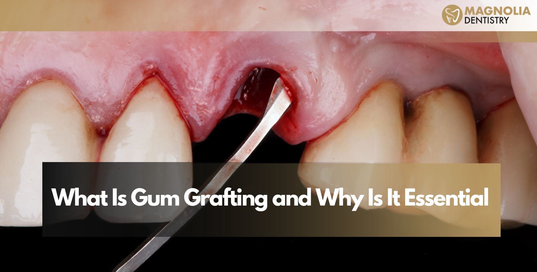 What Is Gum Grafting and Why Is It Essential | Magnolia Dentistry What Is Gum Grafting and Why Is It Essential | Magnolia Dentistry