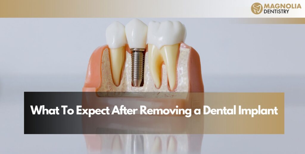 What To Expect After Removing a Dental Implant