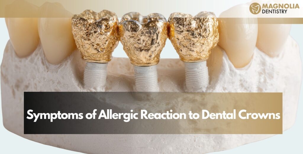 Symptoms of Allergic Reaction to Dental Crowns