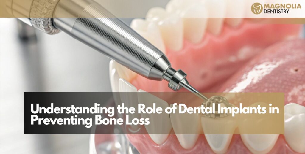 Understanding the Role of Dental Implants in Preventing Bone Loss