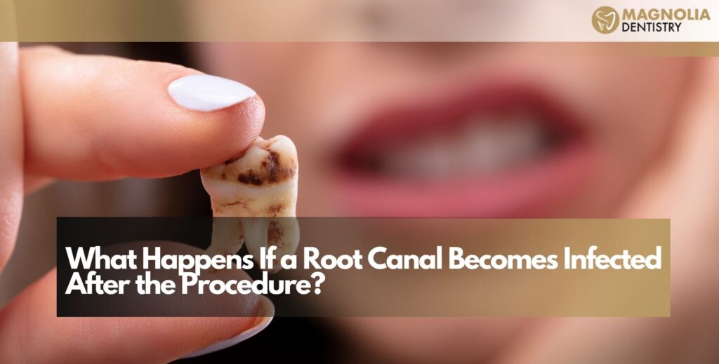 What Happens If a Root Canal Becomes Infected After the Procedure